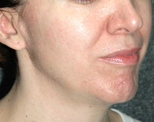 FRAXEL LASER RESURFACING - Patient 1 - After